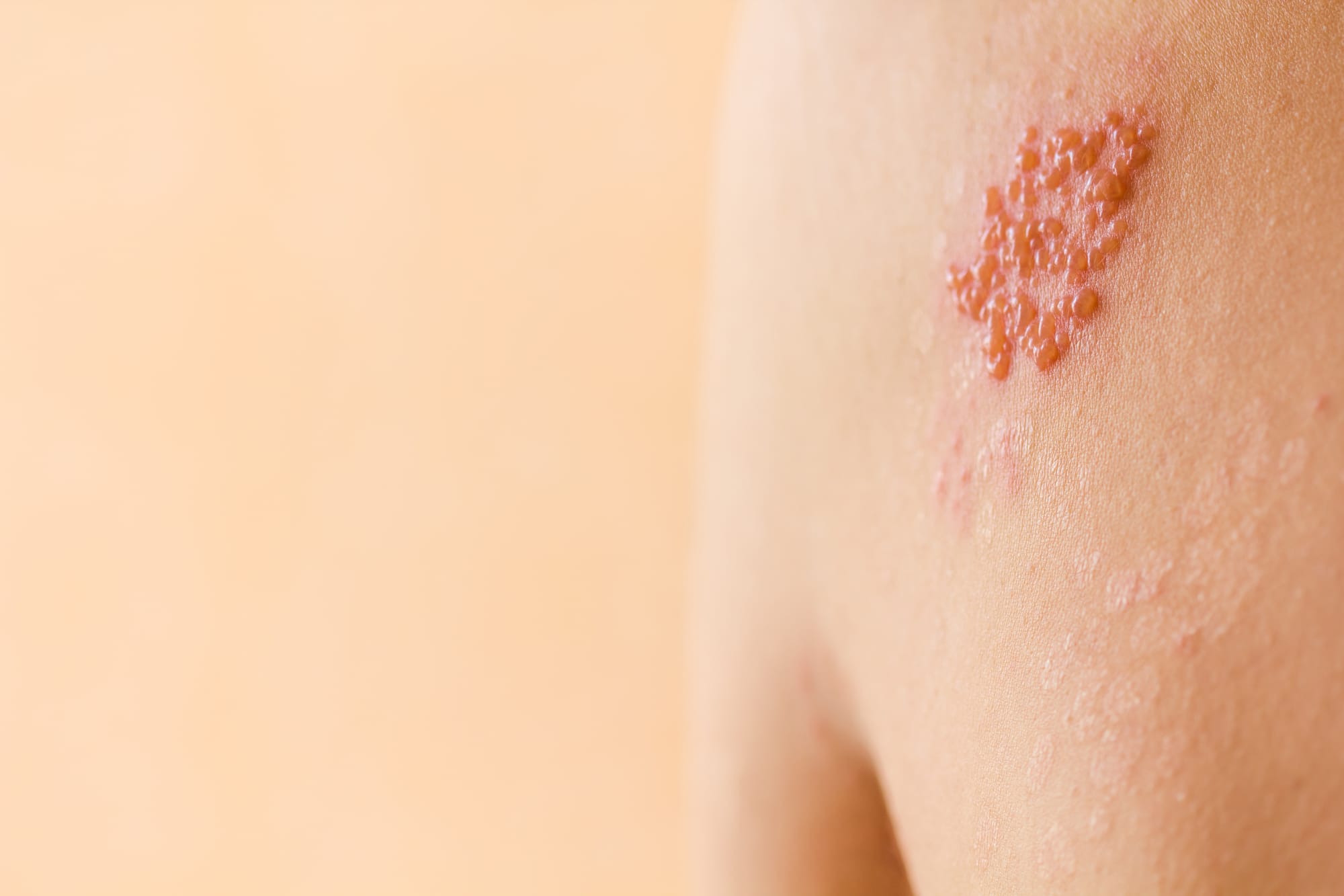 Shingles are not just a band of blisters