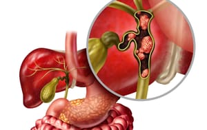 What is cholangiocarcinoma and how is it treated?