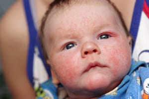 Tips for childhood eczema